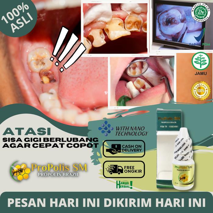 Gambar Obat Kumur Gigi Berlubang Penghilang karang Gigi Bau Mulut PROPOLIS SM dari Haruss Herbal undefined Tokopedia