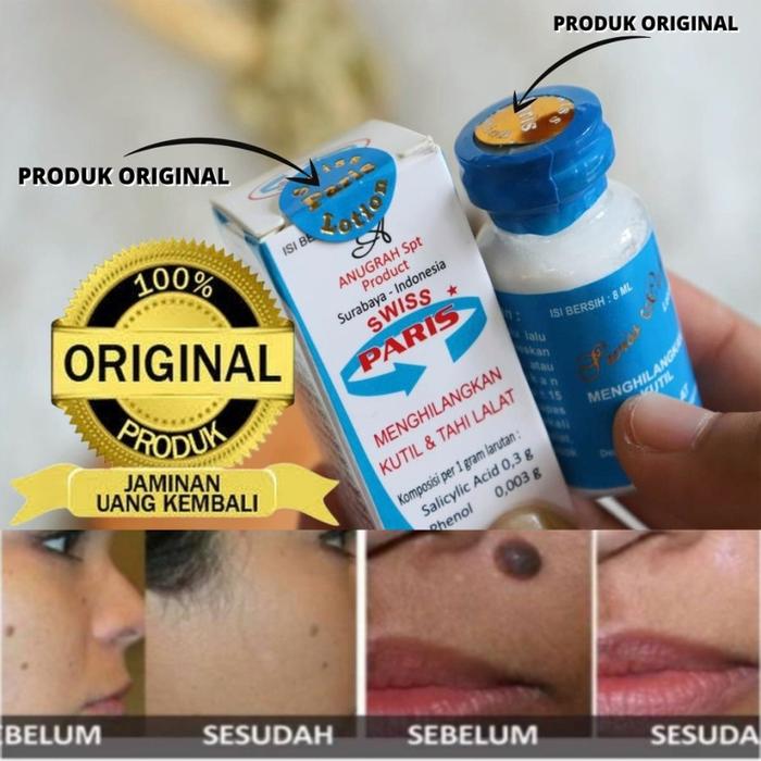 Gambar Obat Kutil Paling Ampuh Penghilang Tahi Lalat Swiss Paris Lotion Original - Swiss Paris dari Alussaeshop undefined Tokopedia
