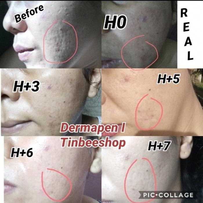 Gambar SET serum anesten repair MTS dermaroller dermapen scars bopeng bb glow dari Tinbeeshop Skincare Pharna undefined Tokopedia