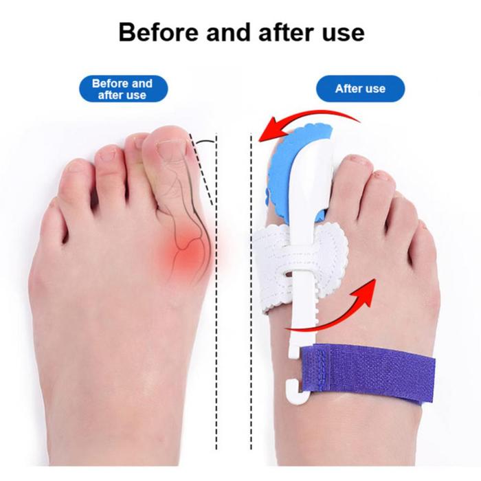 Gambar 1 pasang Bunion hallux valgus orthopedic corrector / pemisah jari kaki - Hallux-Biru dari Bandar Olahraga 2 undefined Tokopedia