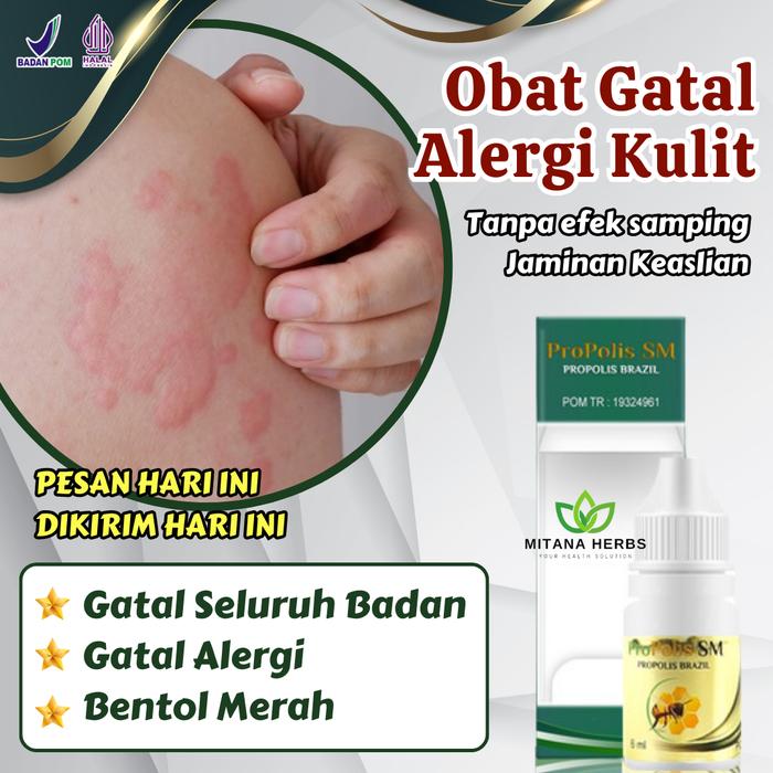 Gambar Obat Gatal Seluruh Badan Alergi Gatal Kulit Eksim Kering Menahun dari Affrian Herbal undefined Tokopedia