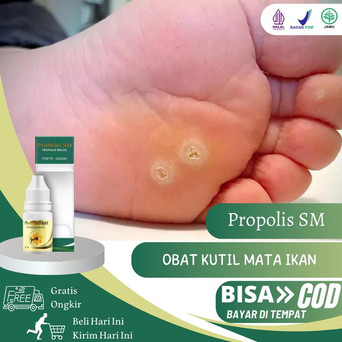 Gambar Propolis SM - Salep Untuk Mata Ikan, Mata ikan di telapak kaki, perontok mata ikan, kutil Di Kaki, KAPALAN dari marsel herbal store undefined Tokopedia