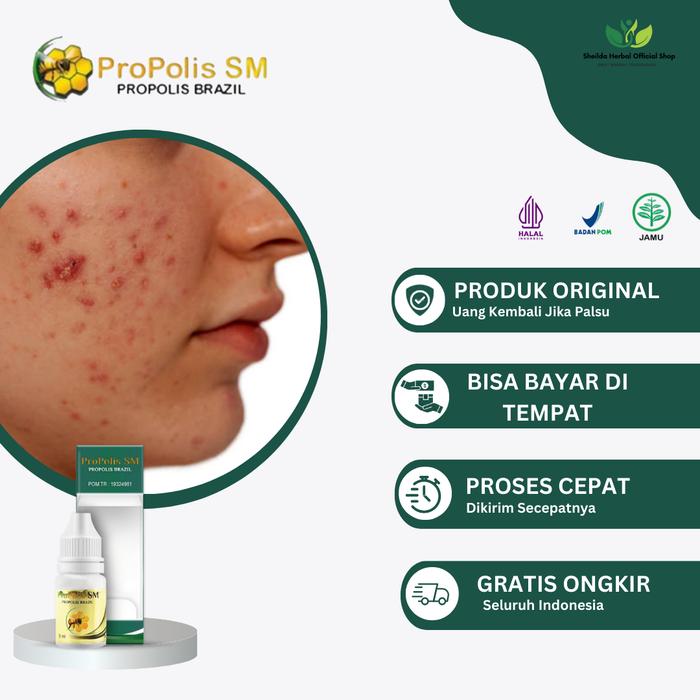 Gambar Propolis SM Mengatasi Jerawat, Bopeng Jerawat, Jerawat Batu,Bekas Jerawat, Bintik Hitam Di Wajah, Jerawat Pria/Wanita, Jerawat Pasir, Jerawat Meradang, Jerawat Merah Berdarah dari Sheilda herbal Shop undefined Tokopedia