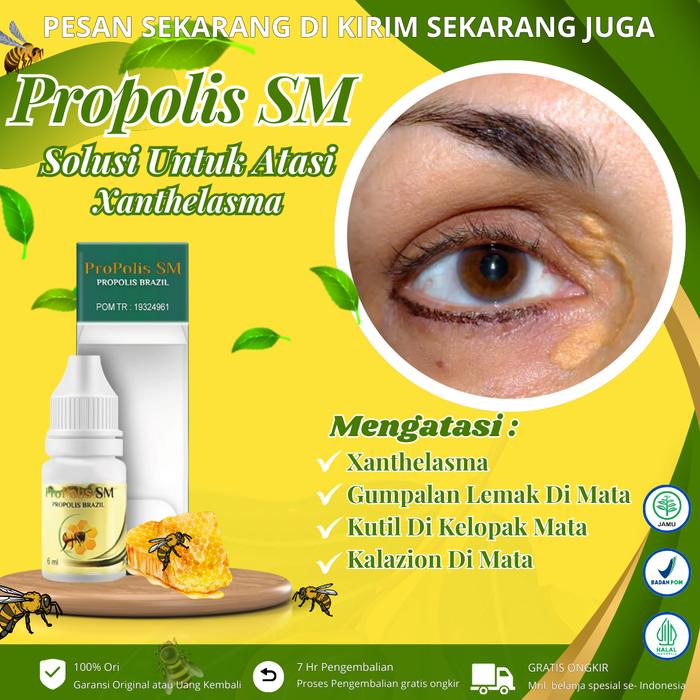 Gambar Propolis Sm - Mengatasi Xanthelasma, Menghilangkan Gumpalan Lemak Di Kelopak Mata, Bintik Kuning Di Kelopak Mata, Salep Xanthelasma dari madayastore undefined Tokopedia
