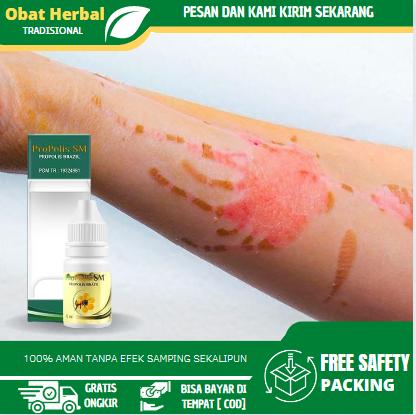 Gambar Cairan Tetes Pengering Luka Bakar, Luka Basah Bernanah, Luka Tersiram Air Panas, Luka Knalpot, Luka Diabetes, Luka Jahitan, Pembersih Bekas Luka Atasi Dengan Propolis sm dari VAN DIHERBALIN undefined Tokopedia
