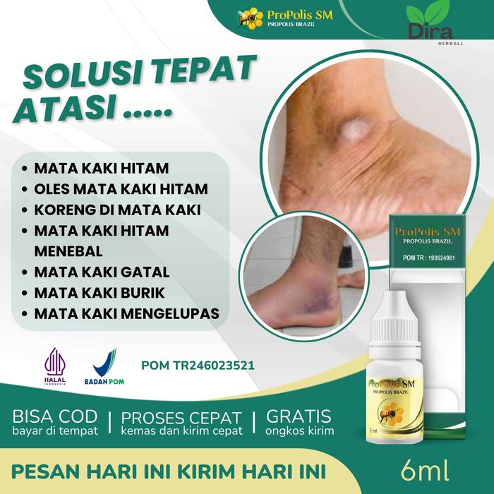 Gambar Propolis SM Herbal Untuk Mata Kaki Hitam, Pemutih Mata Kaki Yang Hitam, Koreng Di Mata Kaki, Mata Kaki Gatal, Mata Kaki Burik, Sakit Mata Kaki Karena Gesekan Sepatu, Obat Kulit Kaki Mengelupas, Penghilang Mata Kaki Hitam Menebal Dengan Propolis SM dari Margaret Herbs Id undefined Tokopedia