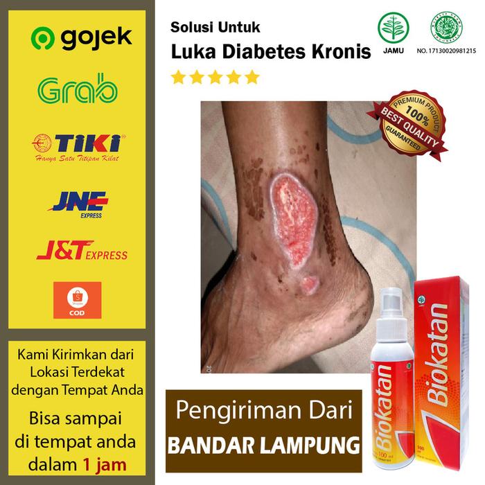 Jual Biokatan Obat Luka Bakar Ulkus Kaki Diabetes Infeksi 100 Ml Cod4 Kota Depok Biokatan Tokopedia
