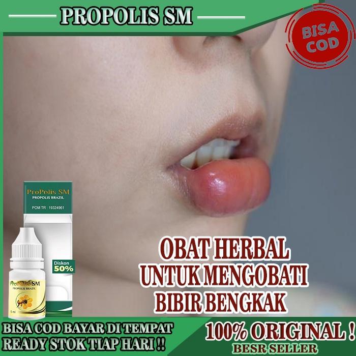 Gambar Obat Bengkak Bibir Obat Bibir Bengkak Alergi Obat Bibir Atas dari sinta dewi store undefined Tokopedia