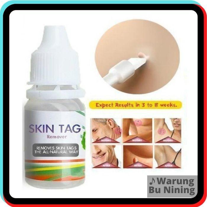 Gambar Mengatasi Kutil & Mata Ikan - Skin Tag Remover dari Warung Bu Nining undefined Tokopedia
