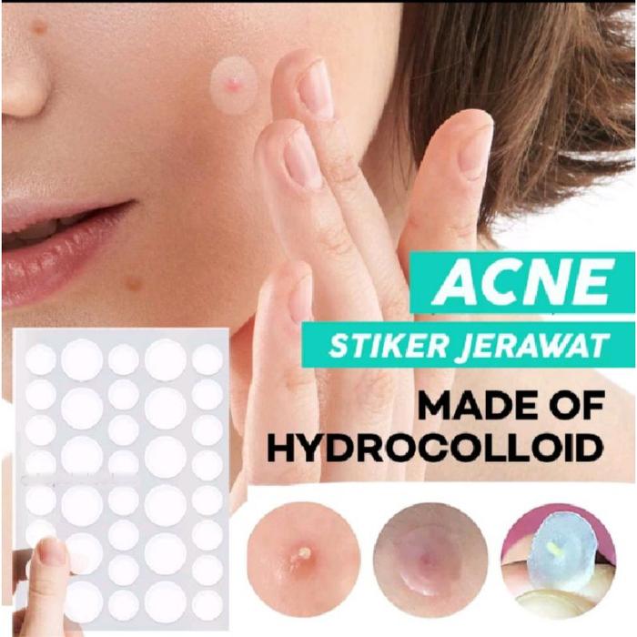 Gambar ACNE PIMPLE PATCH STIKER PENGHILANG JERAWAT 36pc dari OLIVIA COSMETIK_NEW undefined Tokopedia