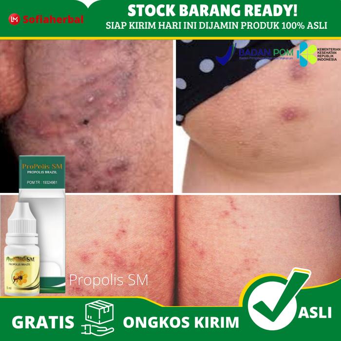 Gambar Obat Pantat Burik, Obat Pantat Gatal, Obat Bokong Burik, Obat Pantat B dari tokoimalbd7788 undefined Tokopedia