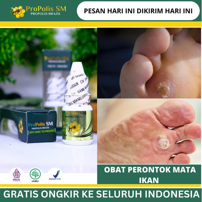 Gambar Solusi Mencegah Agar Tidak Terjadinya Mata Ikan, Mata Ikan Rontok Sendiri Tanpa Perih, Perontok Mata Ikan di Telapak Kaki, Pelunak Mata Ikan Yang Keras, Penghilang Mata Ikan, Pengelupas Mata Ikan, Mata Ikan di Jari Tangan Dengan Propolis Sm dari irvan herbal store undefined Tokopedia