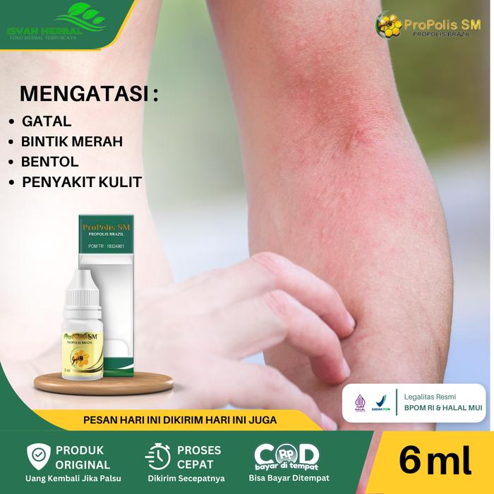Gambar ProPolis SM Untuk Gatal, Gatal Di Seluruh Badan, Gatal Selangkangan, Gatal Jamur, Kaligata, Panu, Kurap, Kadas, Psoriasis, Bisul, Kutil, Kutu Air, Cacar Air, Kudis, Herpes, Scabies, Bintik Merah, Eksim Kering / Basah, Penyakit Kulit, Bentol dari Safari Healthy undefined Tokopedia