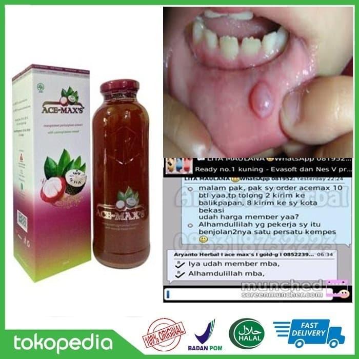 Jual Obat Benjolan Di Bibir Mukokel Ace Maxs 100 Original Kota Tasikmalaya Syukur Herbal Tokopedia