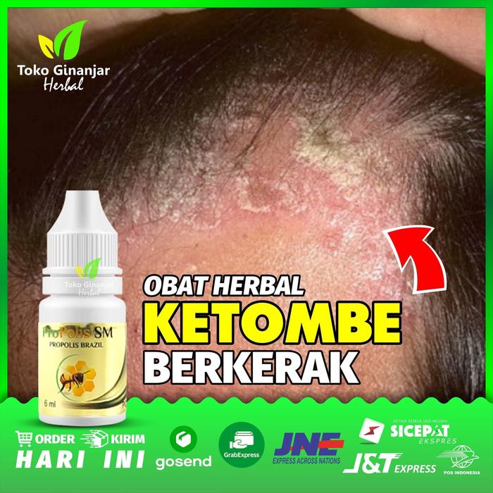 Jual Obat Ketombe Berkerak Obat Ketombe Parah Propolis Sm Kota Surabaya Toko Ginanjar Tokopedia