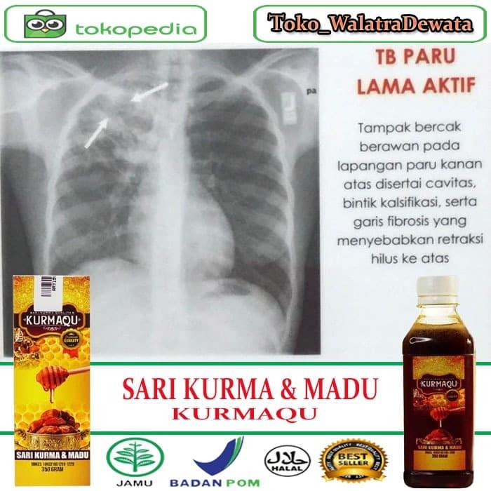 Yuk Simak Manfaat Kurma Untuk Paru Paru 