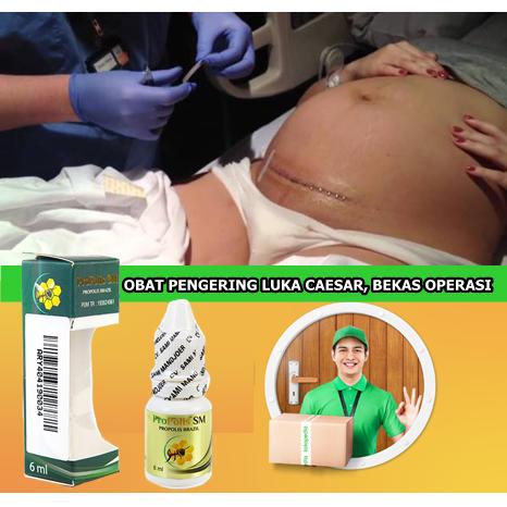 Jual Obat Luka Bekas Operasi Caesar Obat Pengering Luka Caesar Alami Kota Depok Toko Wisma Tokopedia
