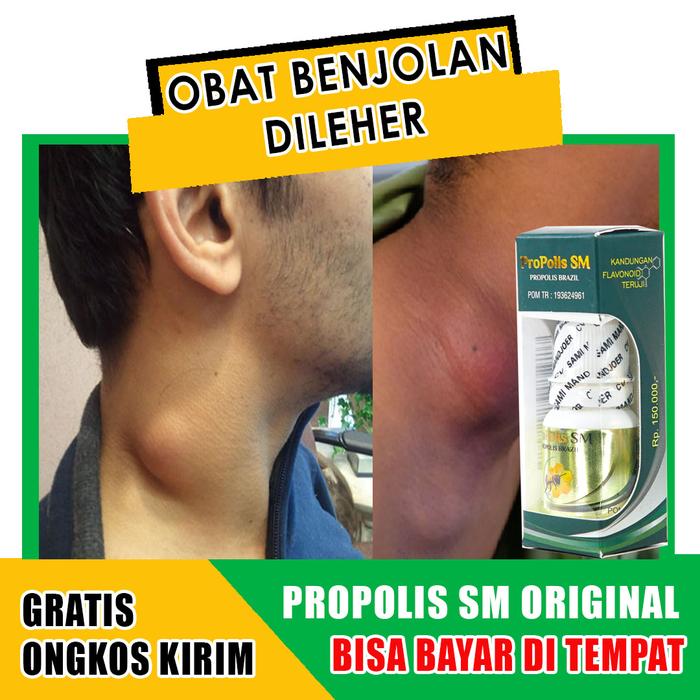 Gambar Obat benjolan dibawah dagu, benjolan di leher,di ketiak kiri dari Berkah Walatra Chanel undefined Tokopedia